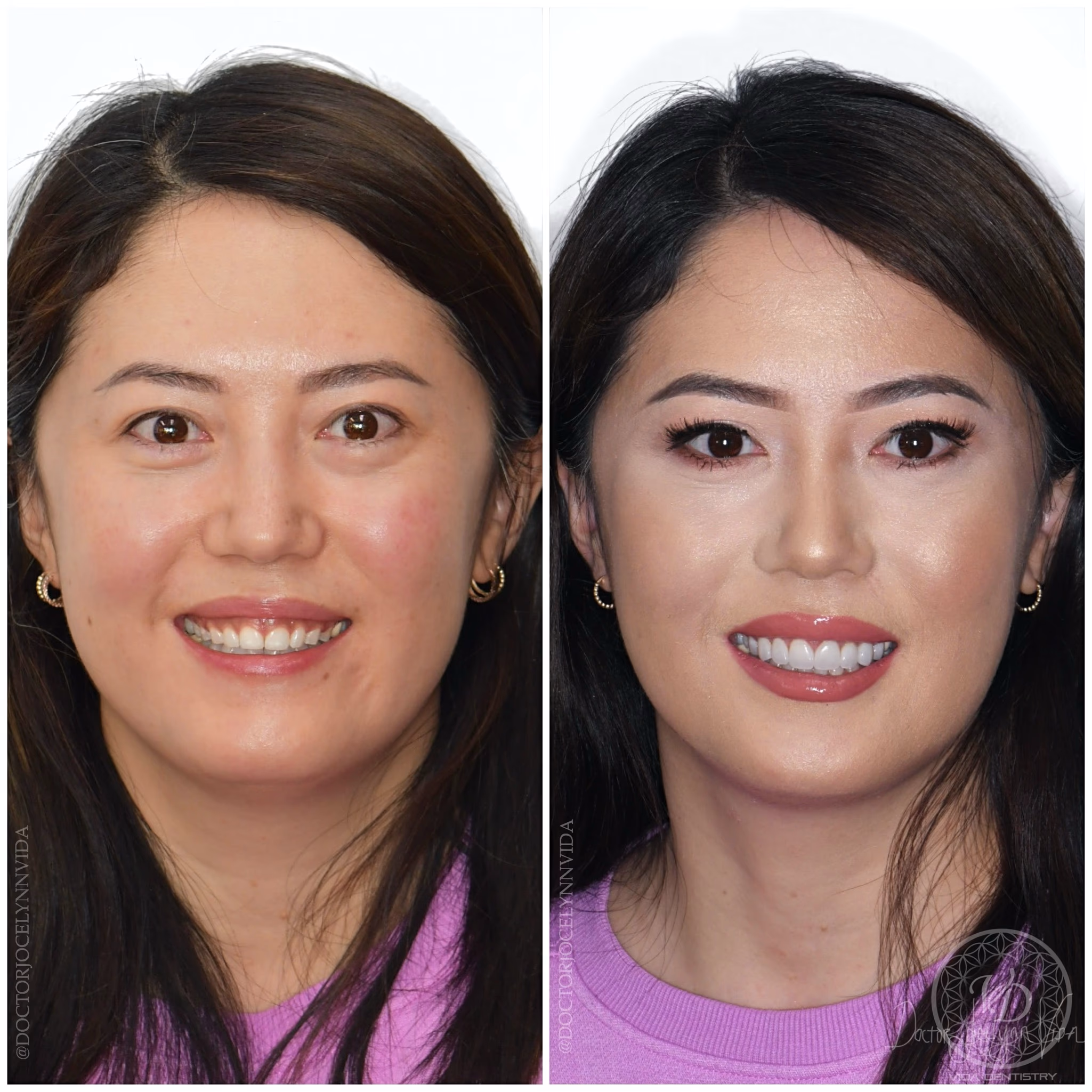Handcrafted porcelain veneers by Dr. Vida.