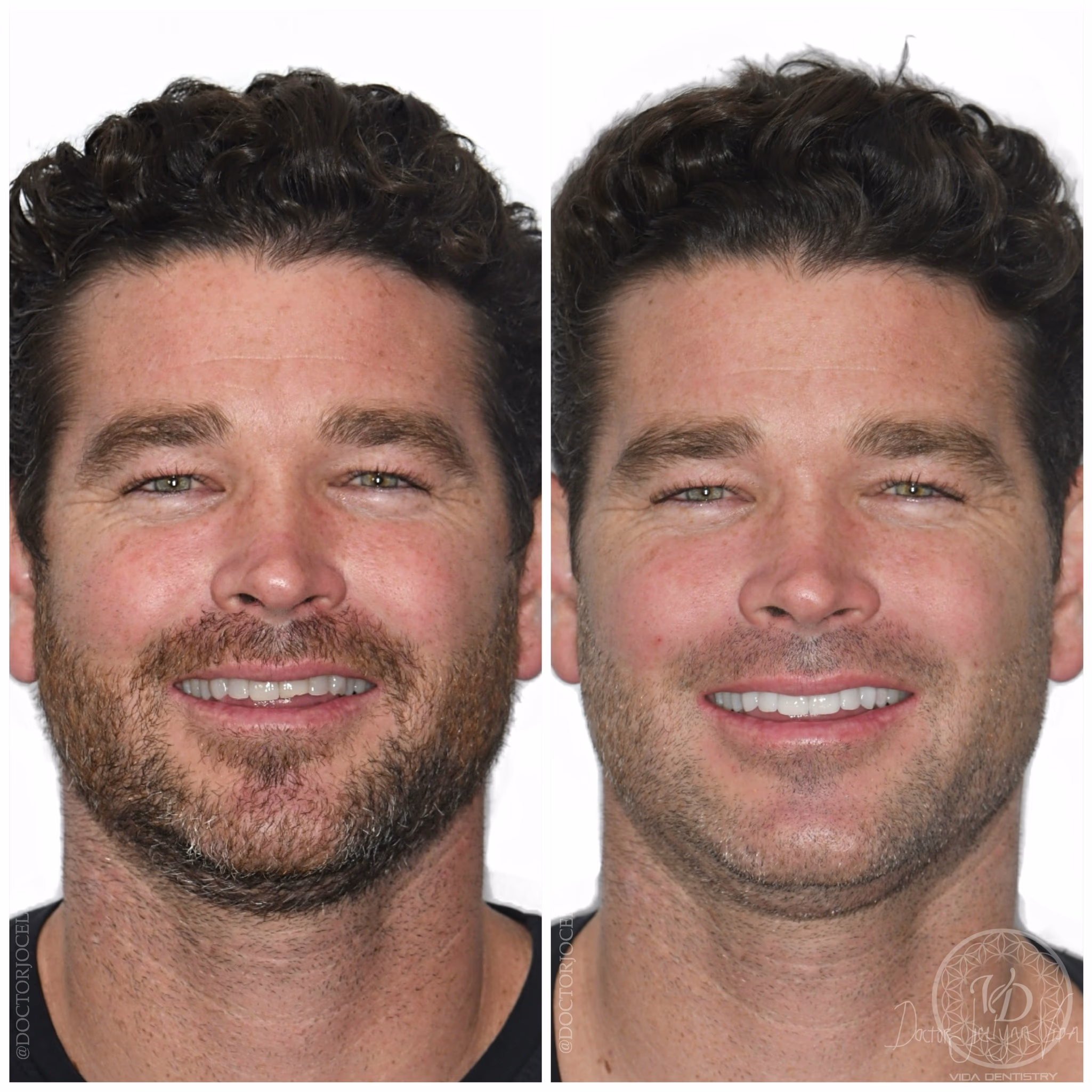 Ultra-natural veneers, designed to suit the face.